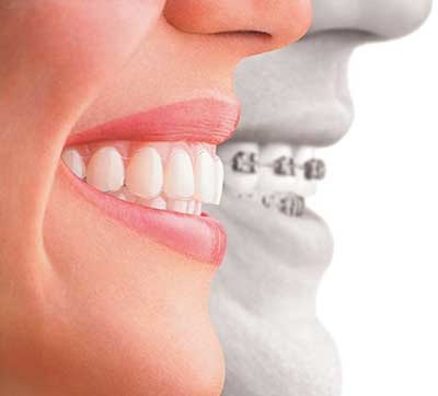 Invisalign-option
