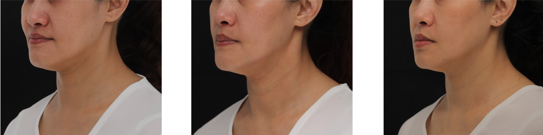 Before, immediately after, and 6 monthw after Thermage FLX treatment.