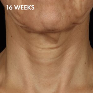 SkinCeuticals Tripeptide-R Neck Repair After 1 16 weeks after treatment with SkinCeuticals Tripeptide-R Neck Repair