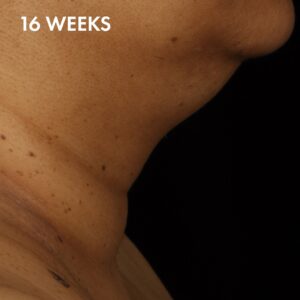 SkinCeuticals Tripeptide-R Neck Repair After 2 16 weeks after treatment with SkinCeuticals Tripeptide-R Neck Repair