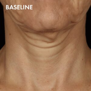 SkinCeuticals Tripeptide-R Neck Repair Before 1 Before treatment with SkinCeuticals Tripeptide-R Neck Repair