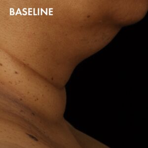 SkinCeuticals Tripeptide-R Neck Repair Before 2 Before treatment with SkinCeuticals Tripeptide-R Neck Repair