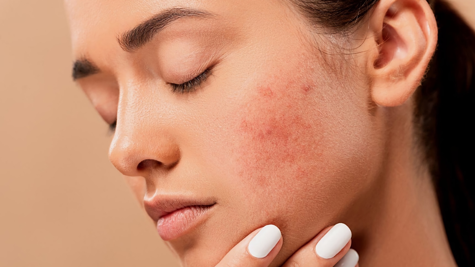 IPL can also help with scars caused by previous acne
