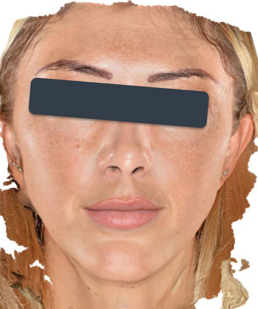 Before LaseMD Treatment