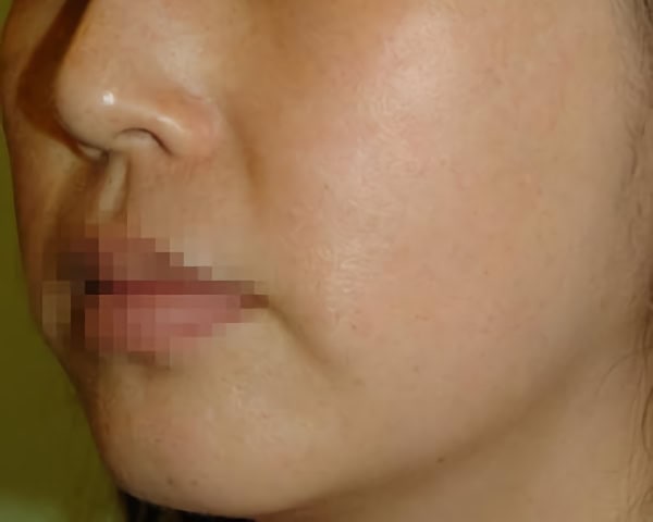 AFTER Hollywood Laser Peel