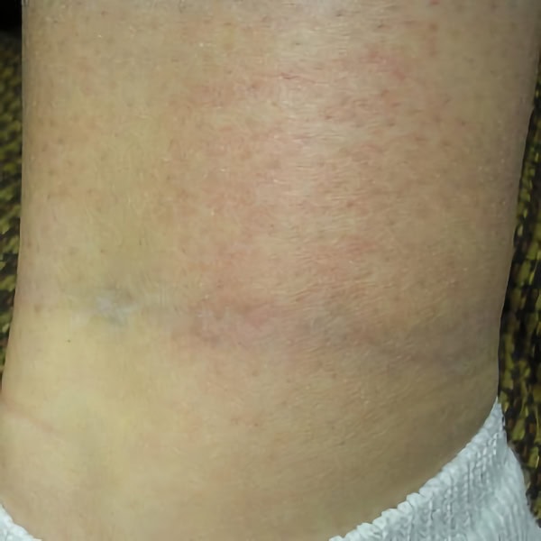 AFTER Hollywood Spectra tattoo removal