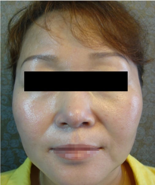 AFTER Healite II treatment