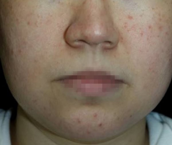 AFTER Healite II treatment