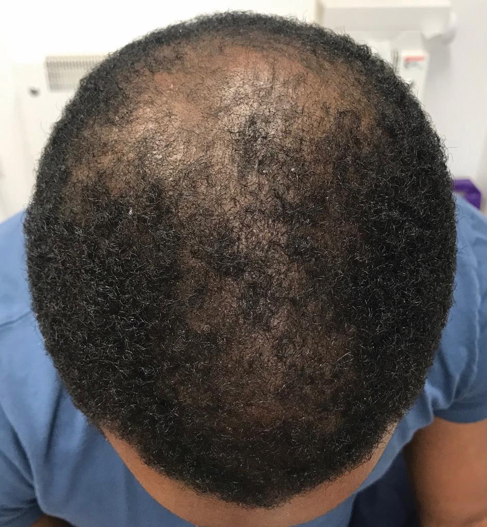 AFTER treatment with CALECIM® Professional Advanced Hair System