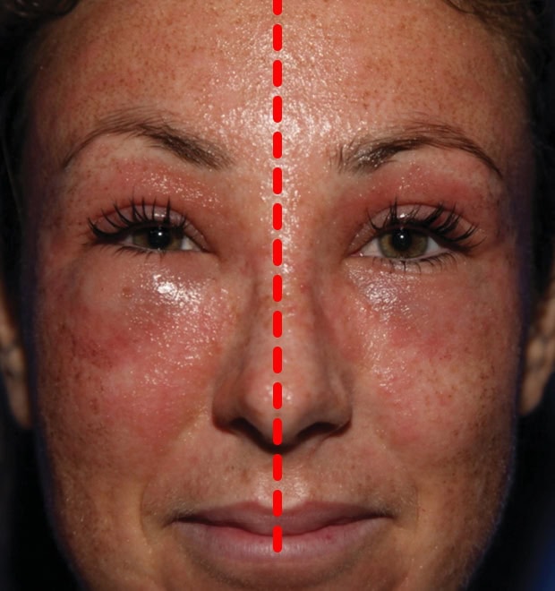 Day 4 AFTER procedure: Decreased swelling AFTER on LHS using CALECIM